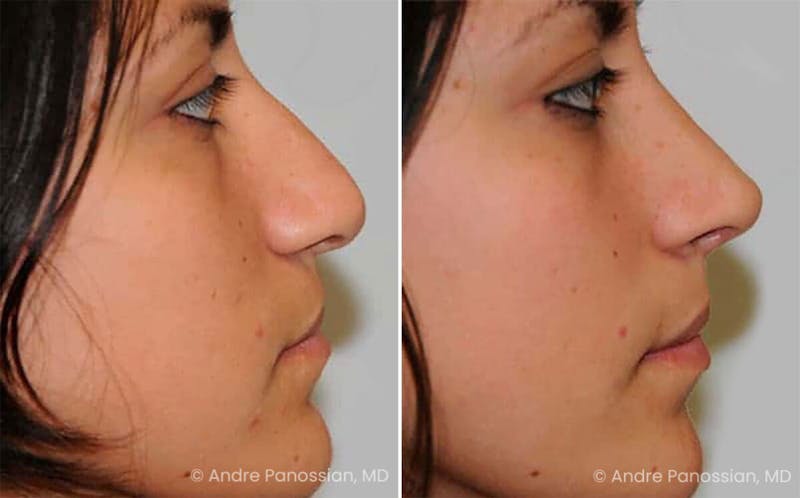 Cleft Lip Rhinoplasty Before & After Gallery - Patient 141370 - Image 1