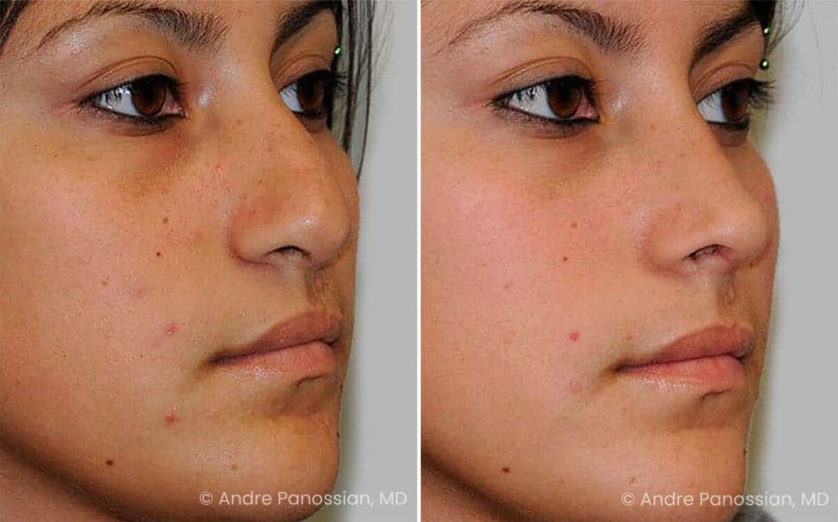 Cleft Lip Rhinoplasty Before & After Gallery - Patient 141370 - Image 3