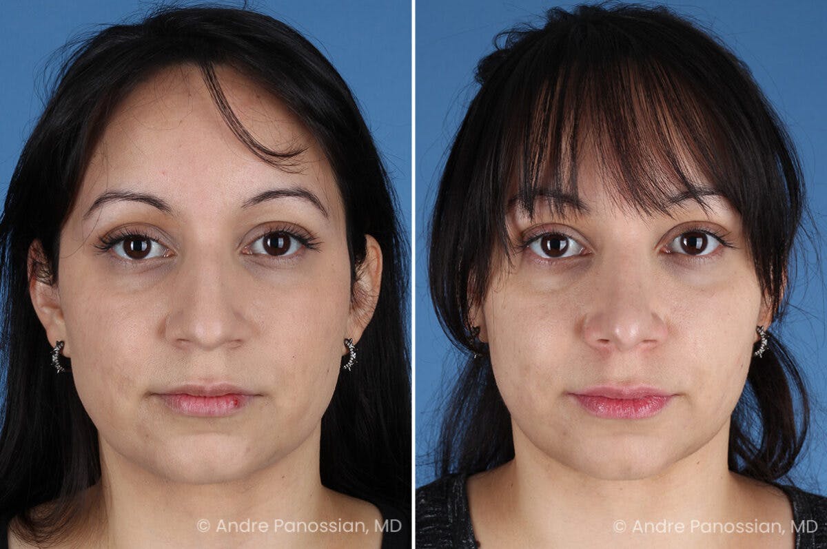 Rhinoplasty Before & After Gallery - Patient 680927 - Image 2
