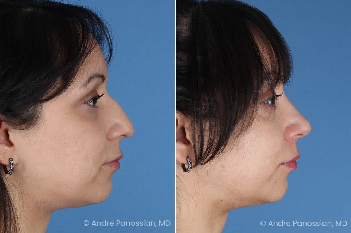 Rhinoplasty Before & After Gallery - Patient 680927 - Image 1