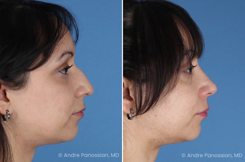 Rhinoplasty Before & After Gallery - Patient 680927 - Image 1