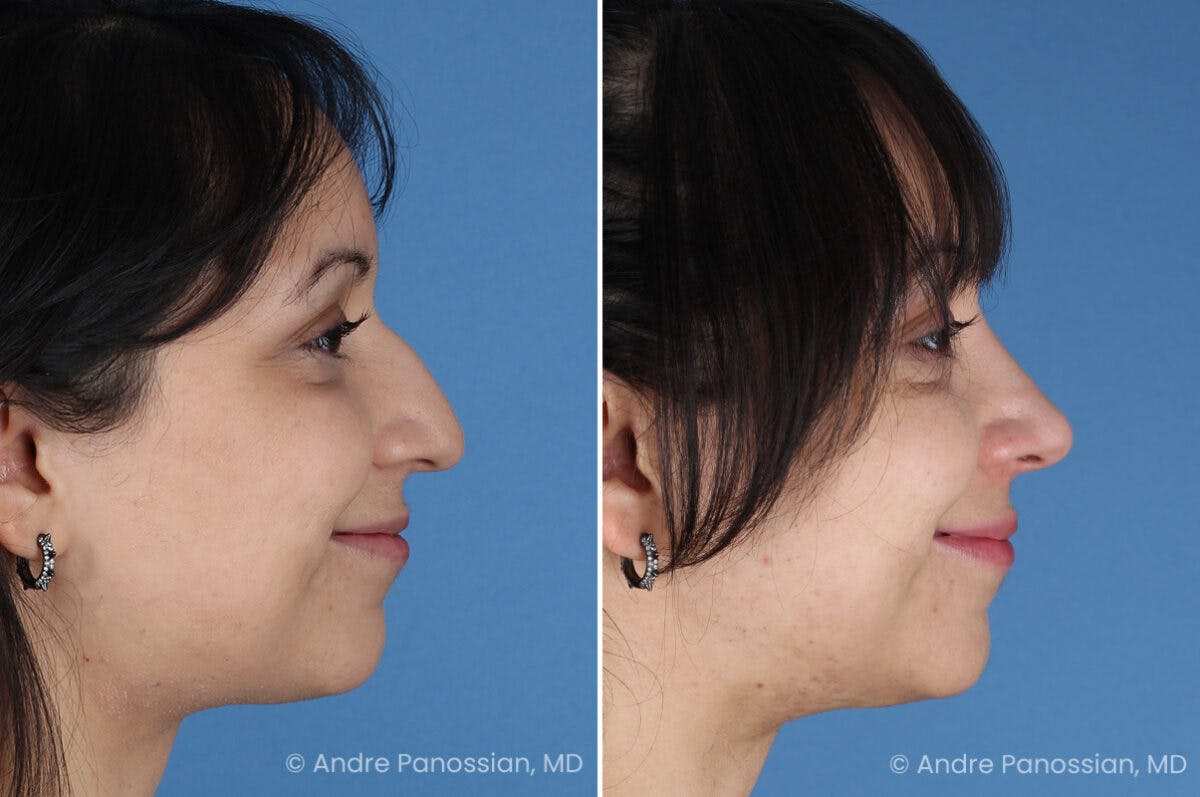 Rhinoplasty Before & After Gallery - Patient 680927 - Image 4