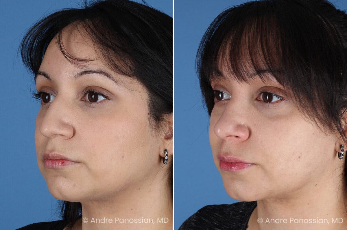 Rhinoplasty Before & After Gallery - Patient 680927 - Image 5