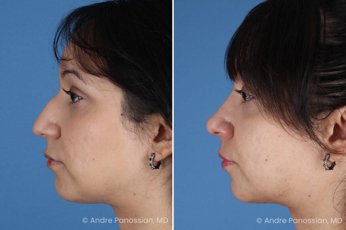 Rhinoplasty Before & After Gallery - Patient 680927 - Image 6