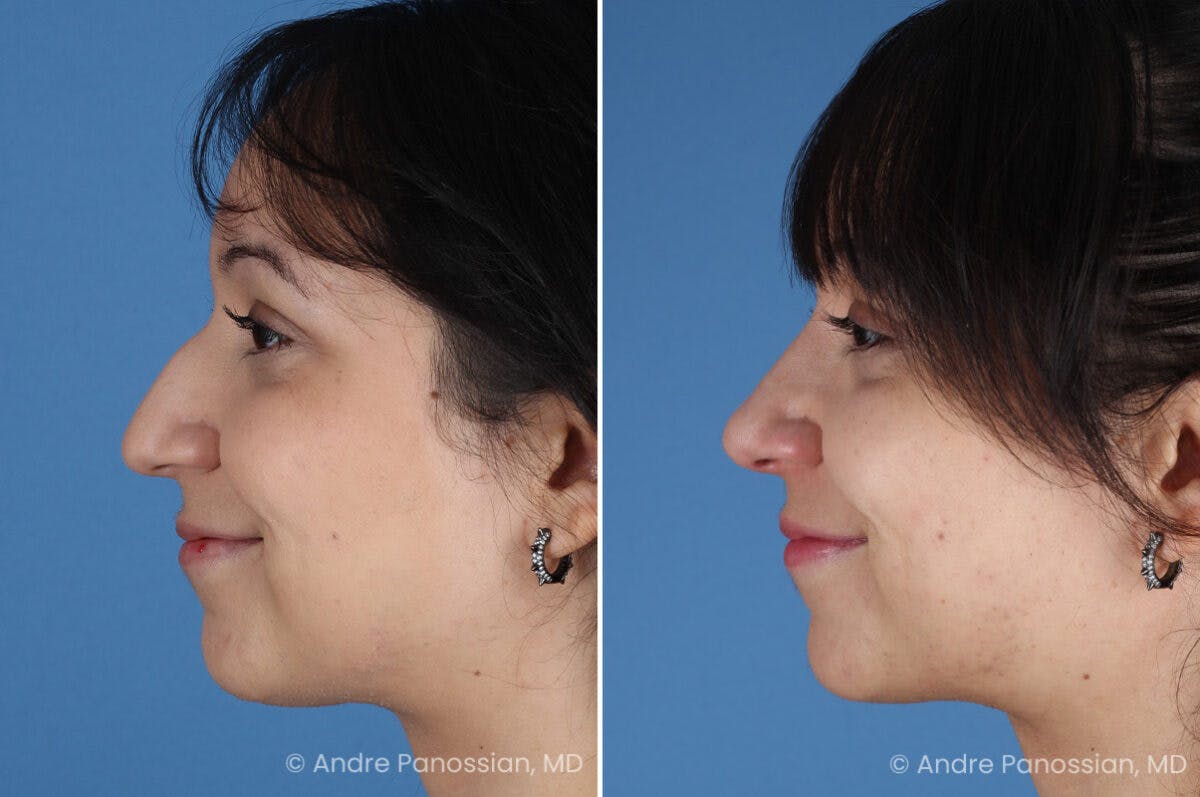 Rhinoplasty Before & After Gallery - Patient 680927 - Image 7