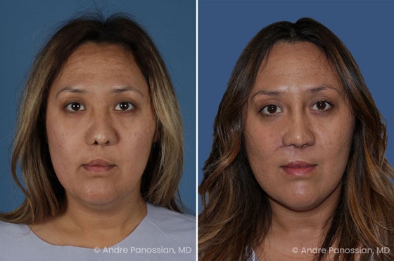 Cleft rhinoplasty before and after — actual patient of Andre Panossian, MD