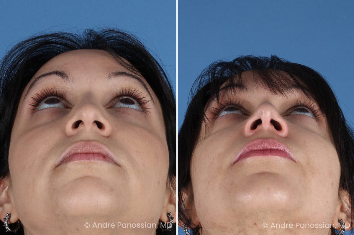 Rhinoplasty Before & After Gallery - Patient 680927 - Image 8