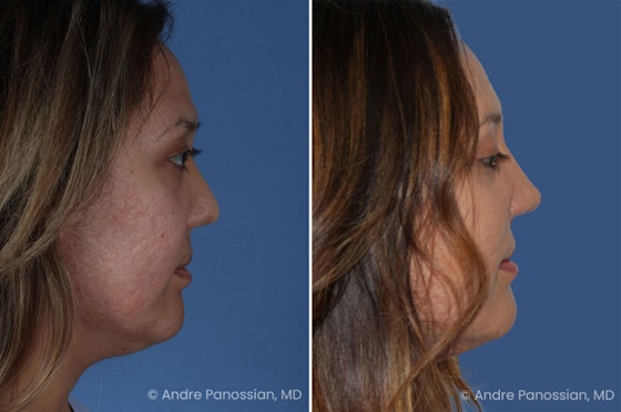 Cleft rhinoplasty before and after — actual patient of Andre Panossian, MD