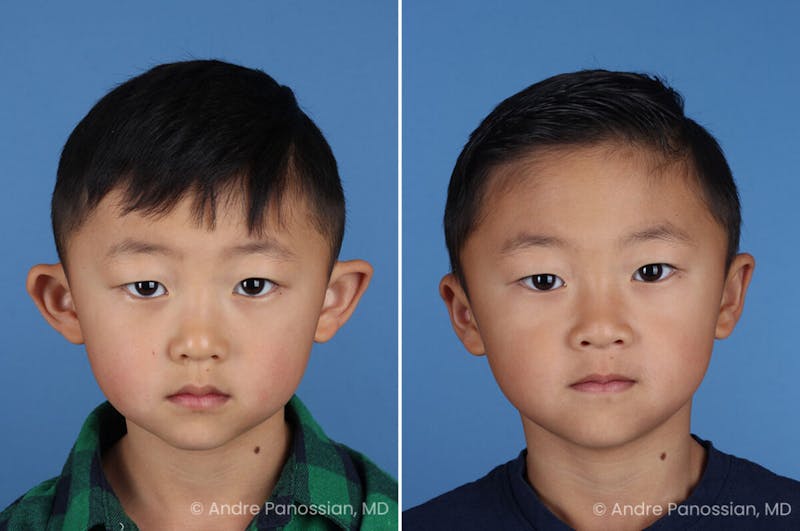 Ear Pinning (Otoplasty) Before & After Gallery - Patient 427493 - Image 1