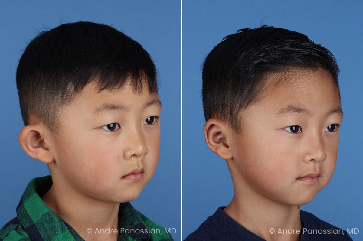 Ear Pinning (Otoplasty) Before & After Gallery - Patient 427493 - Image 2
