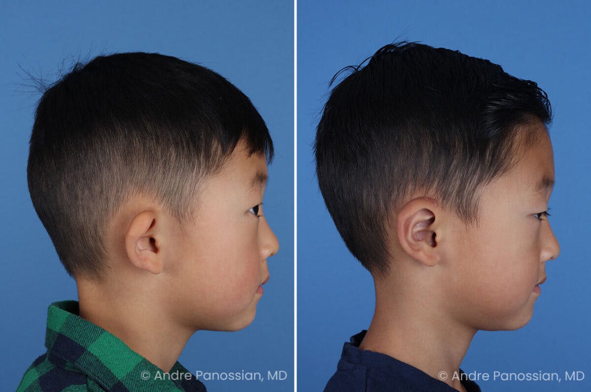 Ear Pinning (Otoplasty) Before & After Gallery - Patient 427493 - Image 3