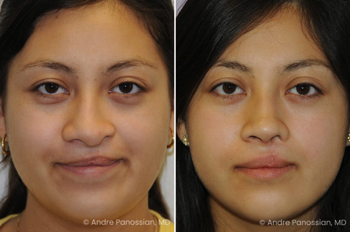 Cleft Lip Rhinoplasty Before & After Gallery - Patient 417908 - Image 2