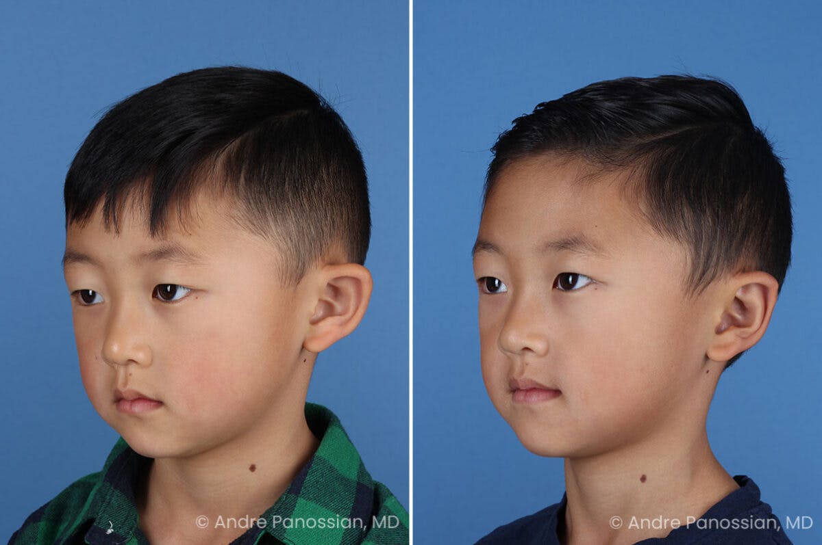 Ear Pinning (Otoplasty) Before & After Gallery - Patient 427493 - Image 4