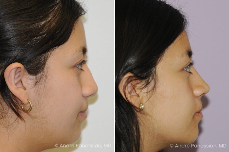 Cleft Lip Rhinoplasty Before & After Gallery - Patient 417908 - Image 1