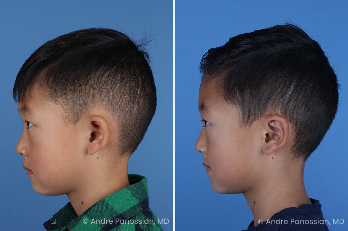 Ear Pinning (Otoplasty) Before & After Gallery - Patient 427493 - Image 5