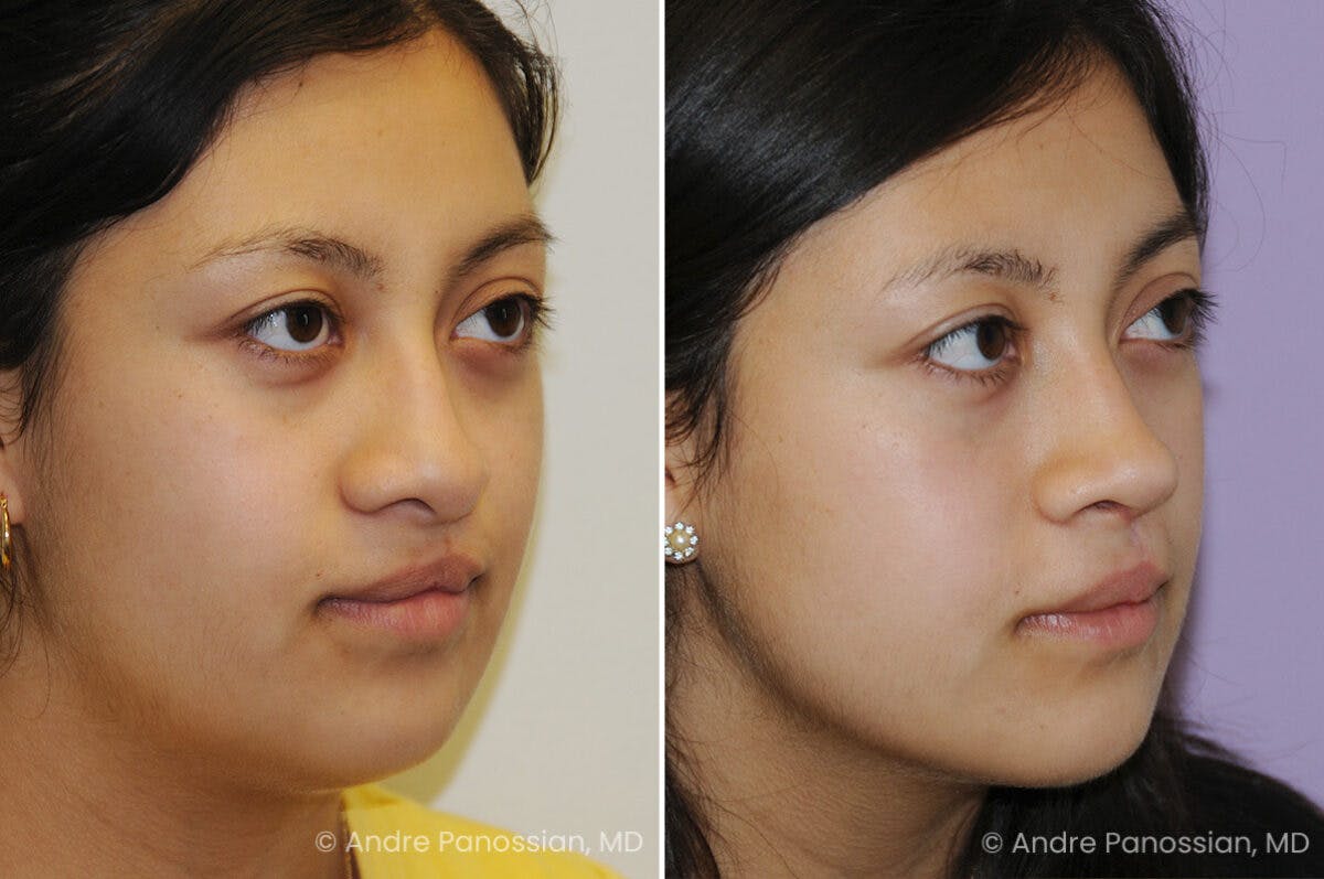 Cleft Lip Rhinoplasty Before & After Gallery - Patient 417908 - Image 3