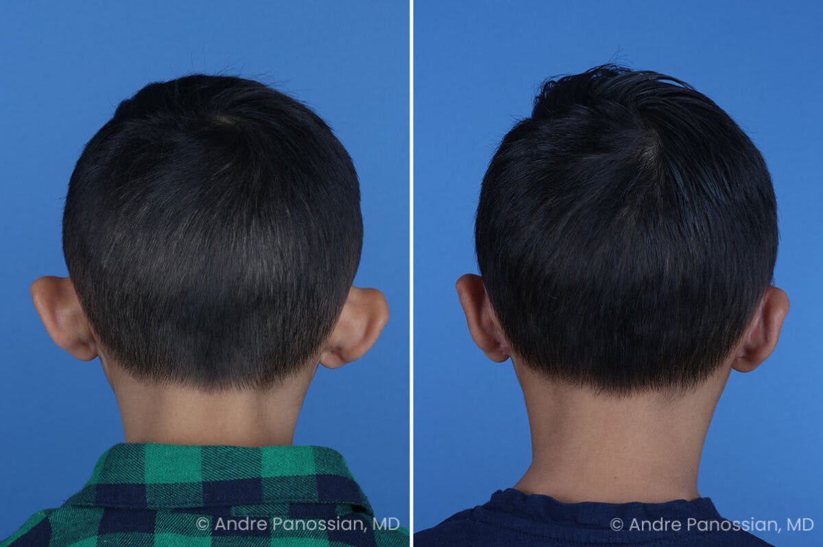 Ear Pinning (Otoplasty) Before & After Gallery - Patient 427493 - Image 6