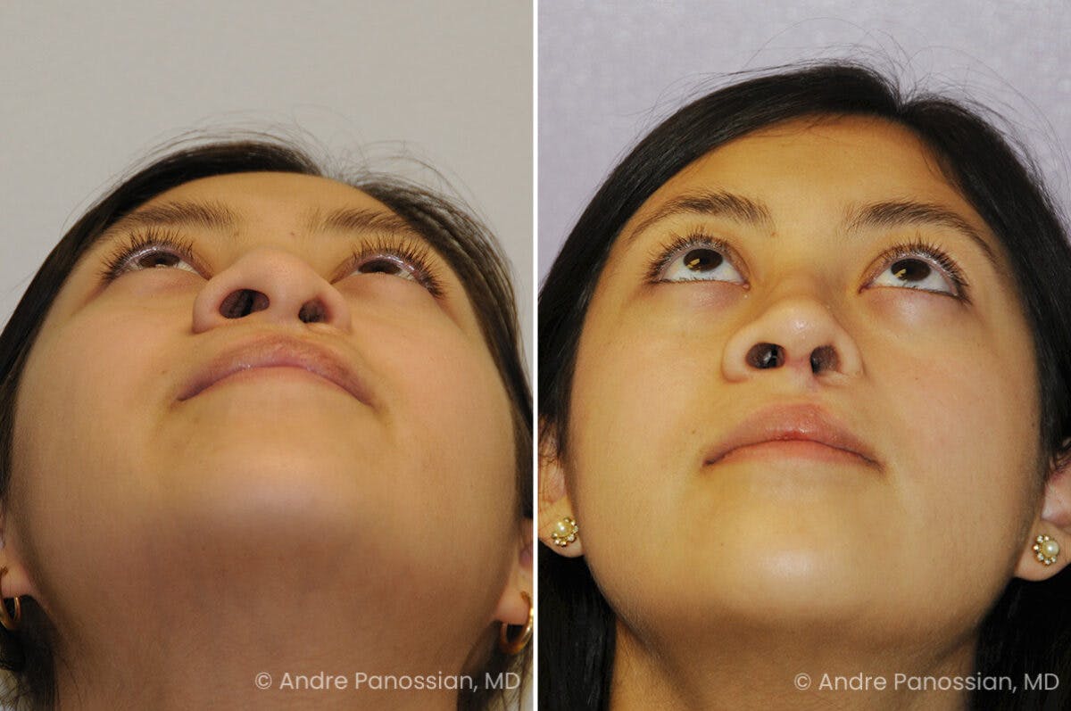 Cleft Lip Rhinoplasty Before & After Gallery - Patient 417908 - Image 4