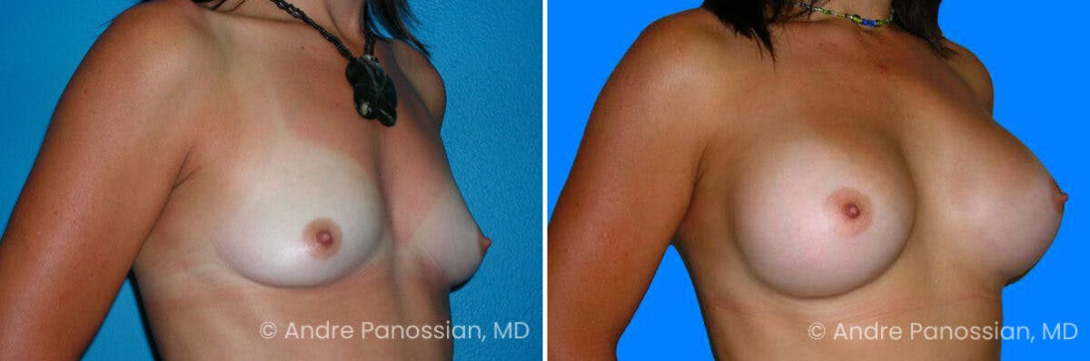 Breast Augmentation Before & After Gallery - Patient 166447 - Image 1