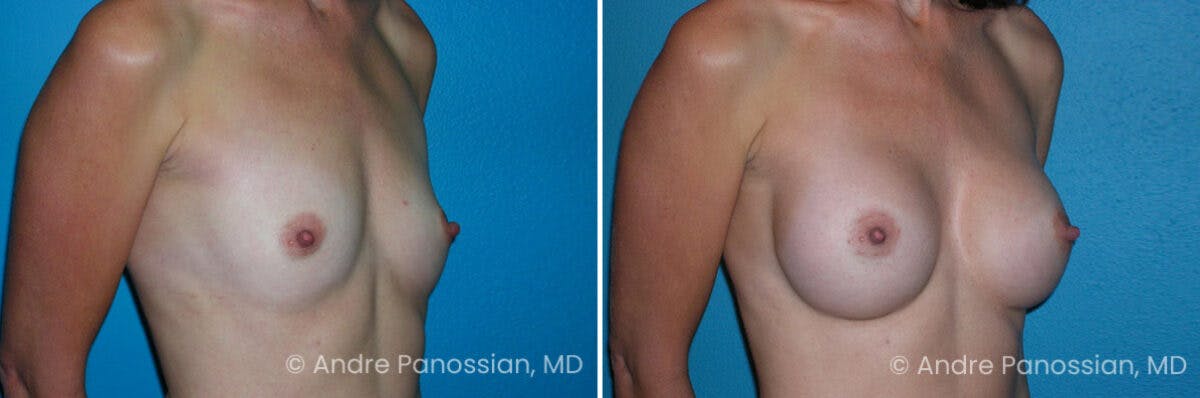 Breast Augmentation Before & After Gallery - Patient 322010 - Image 1