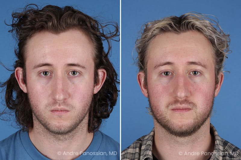 Ear Pinning (Otoplasty) Before & After Gallery - Patient 205641 - Image 1