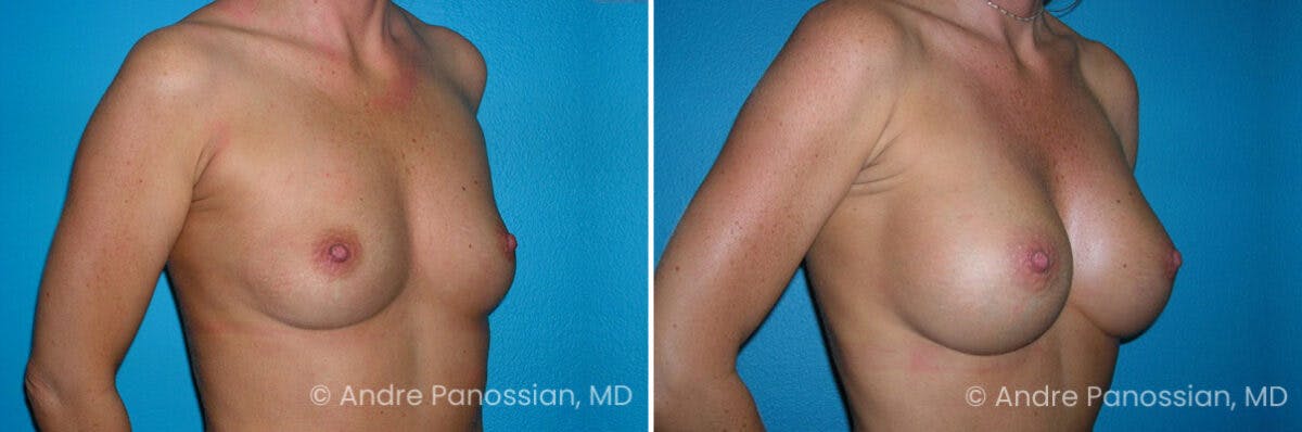 Breast Augmentation Before & After Gallery - Patient 367508 - Image 1