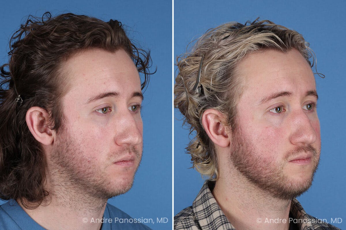 Ear Pinning (Otoplasty) Before & After Gallery - Patient 205641 - Image 2