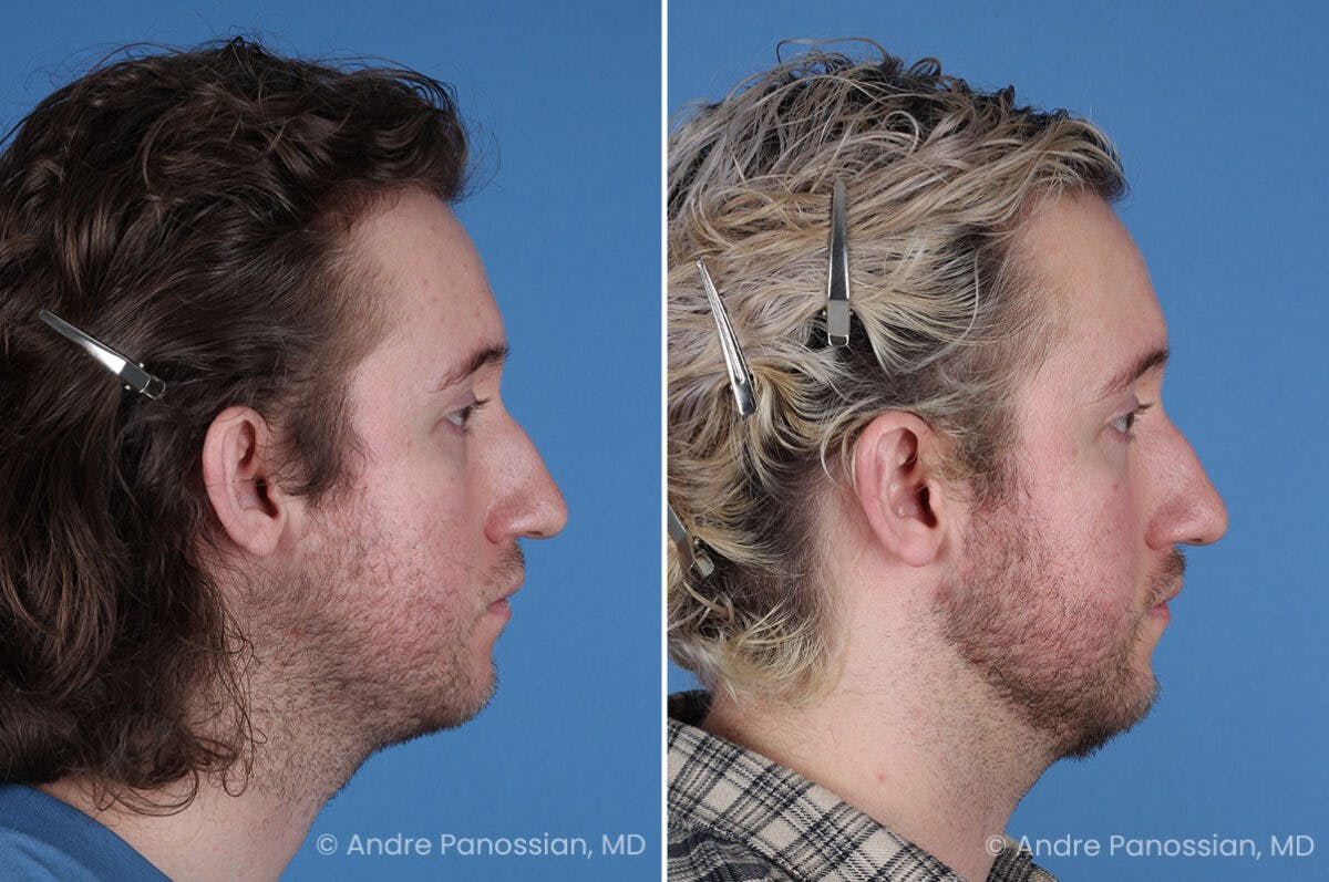 Ear Pinning (Otoplasty) Before & After Gallery - Patient 205641 - Image 3