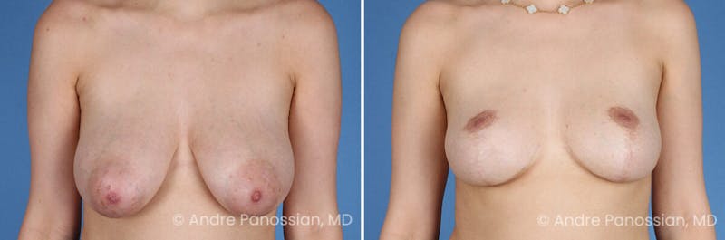 Breast Lift/Reduction Before & After Gallery - Patient 414920 - Image 1