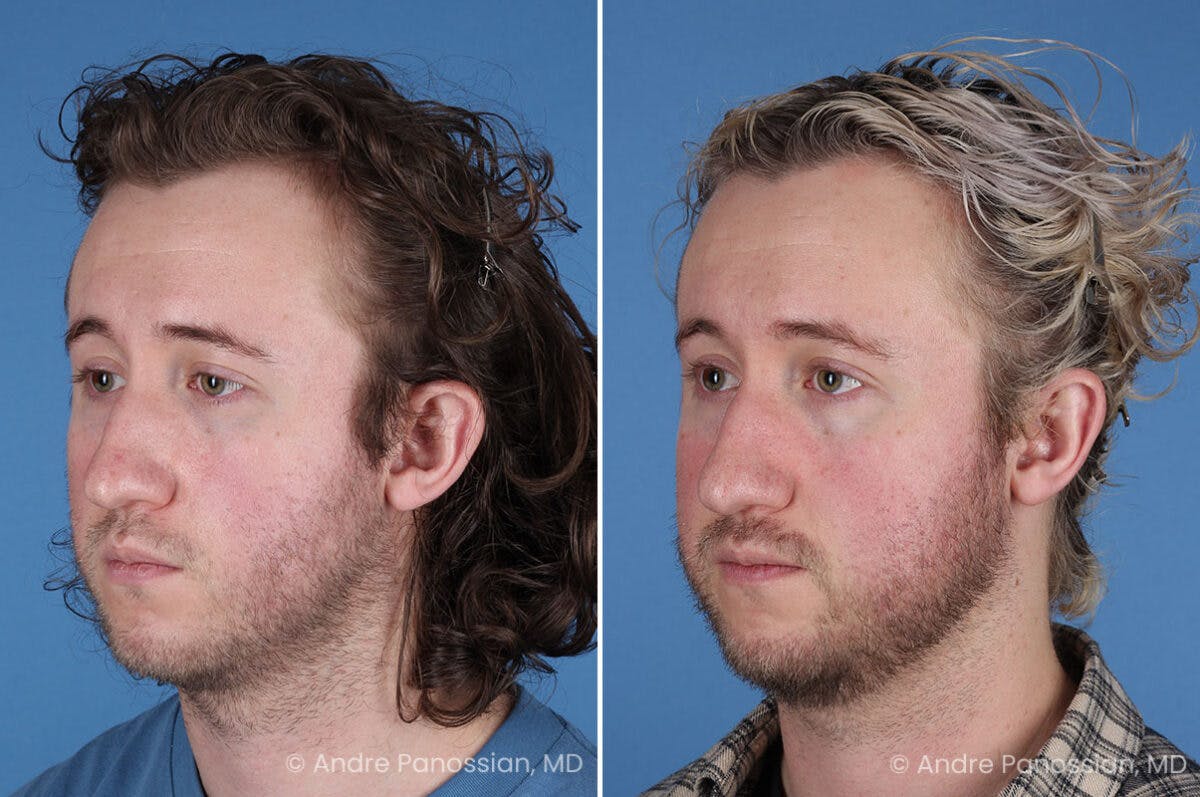 Ear Pinning (Otoplasty) Before & After Gallery - Patient 205641 - Image 4