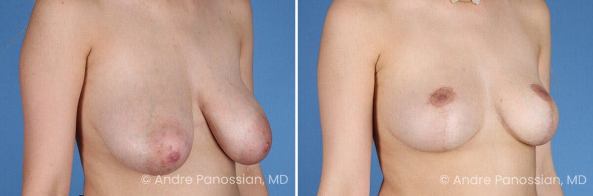 Breast Lift/Reduction Before & After Gallery - Patient 414920 - Image 2