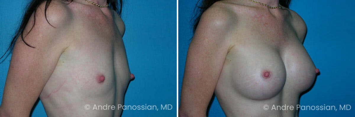Breast Augmentation Before & After Gallery - Patient 368081 - Image 1