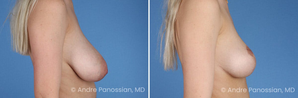 Breast Lift/Reduction Before & After Gallery - Patient 414920 - Image 3
