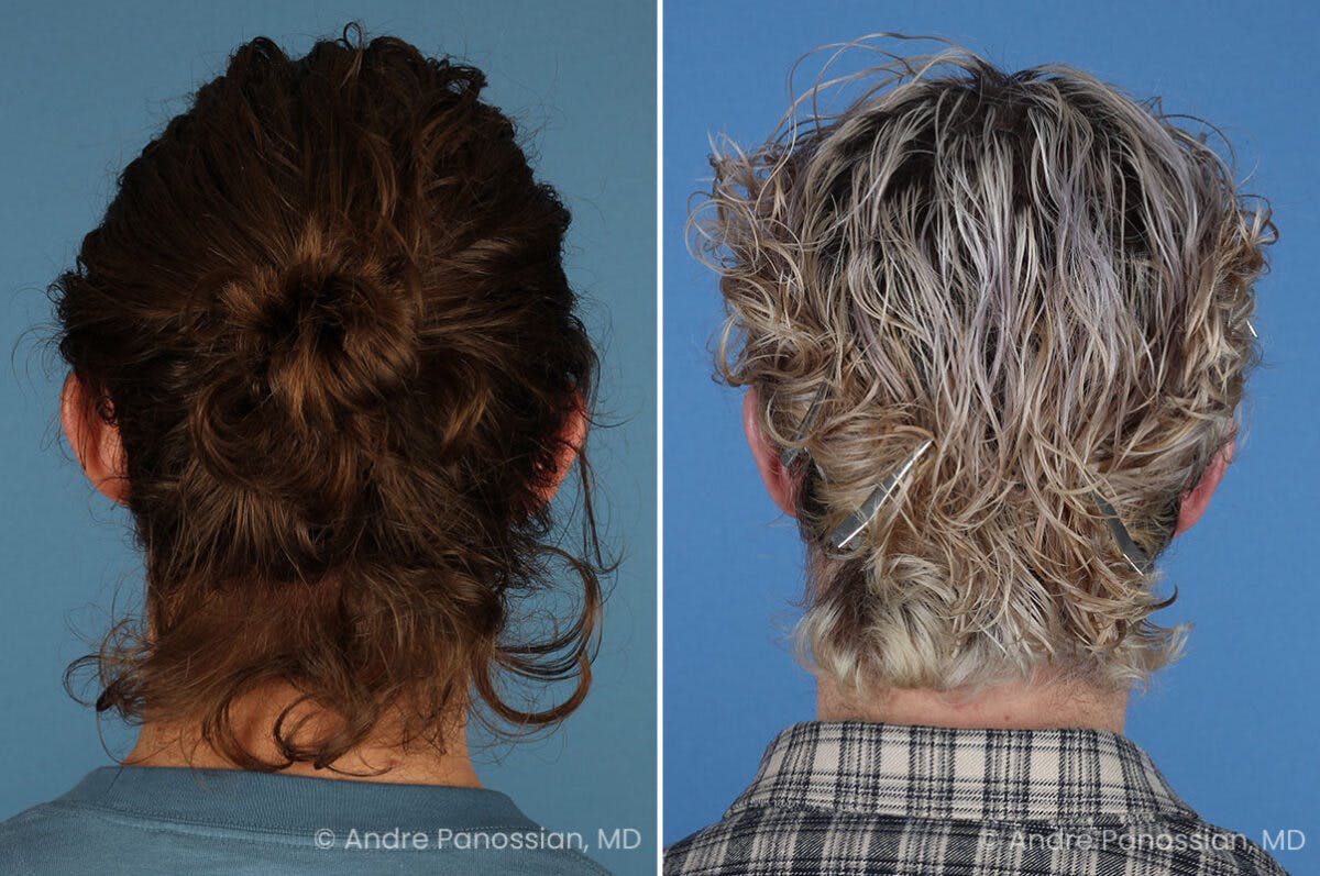 Ear Pinning (Otoplasty) Before & After Gallery - Patient 205641 - Image 5