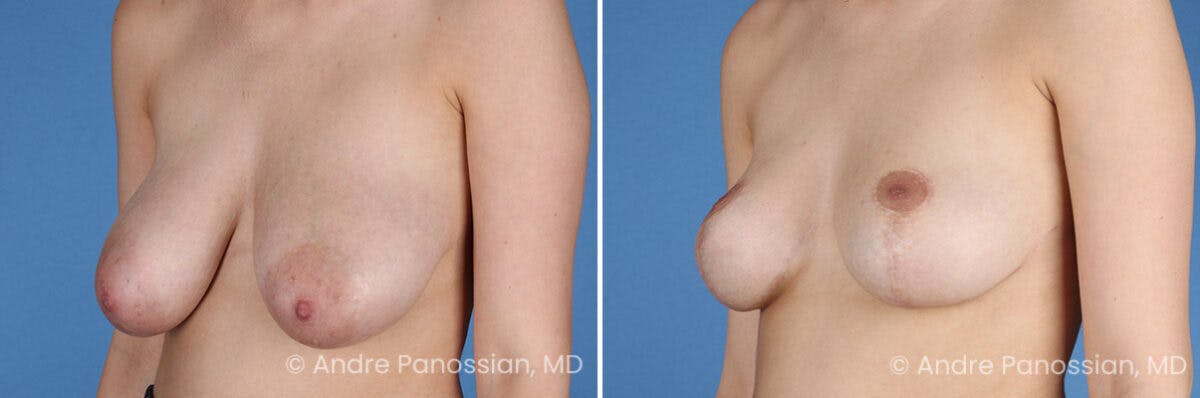Breast Lift/Reduction Before & After Gallery - Patient 414920 - Image 4