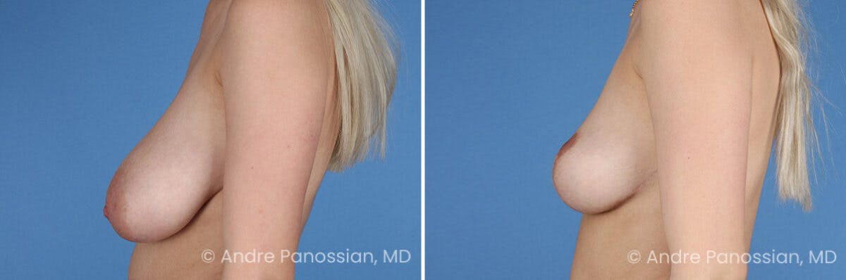 Breast Lift/Reduction Before & After Gallery - Patient 414920 - Image 5