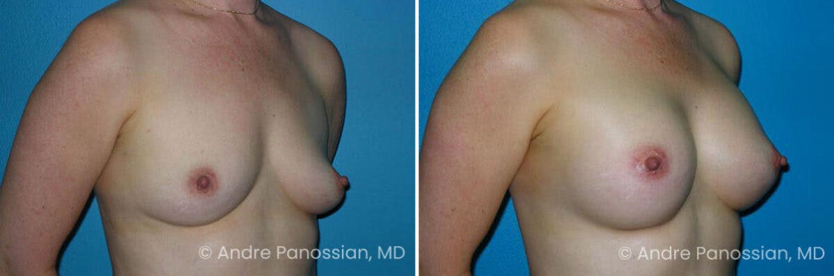 Breast Augmentation Before & After Gallery - Patient 676954 - Image 1