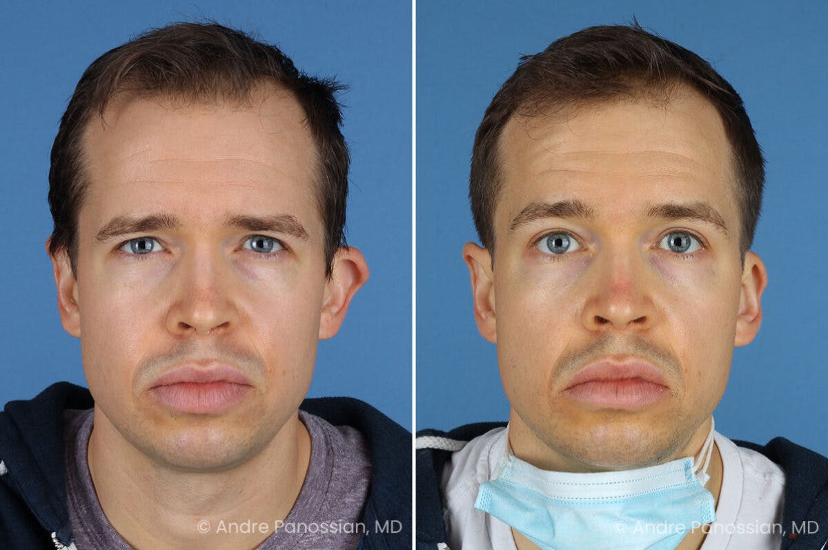 Ear Pinning (Otoplasty) Before & After Gallery - Patient 365074 - Image 1