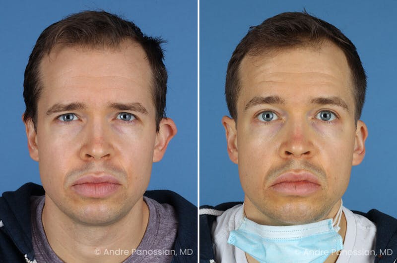 Ear Pinning (Otoplasty) Before & After Gallery - Patient 365074 - Image 1
