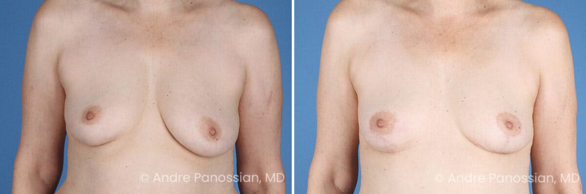 Breast Lift/Reduction Before & After Gallery - Patient 330732 - Image 1