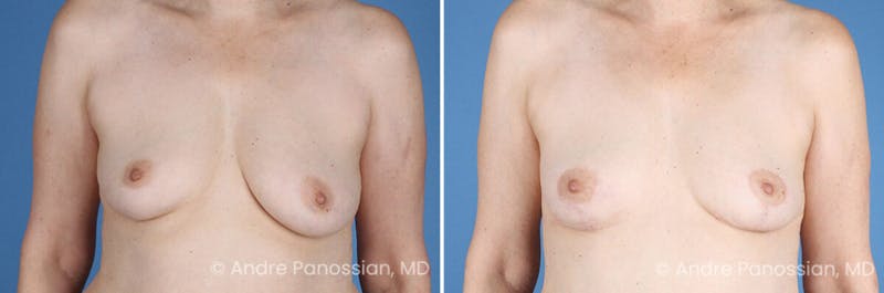 Breast Lift/Reduction Before & After Gallery - Patient 330732 - Image 1