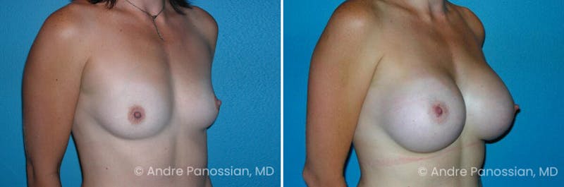 Breast Augmentation Before & After Gallery - Patient 374987 - Image 1