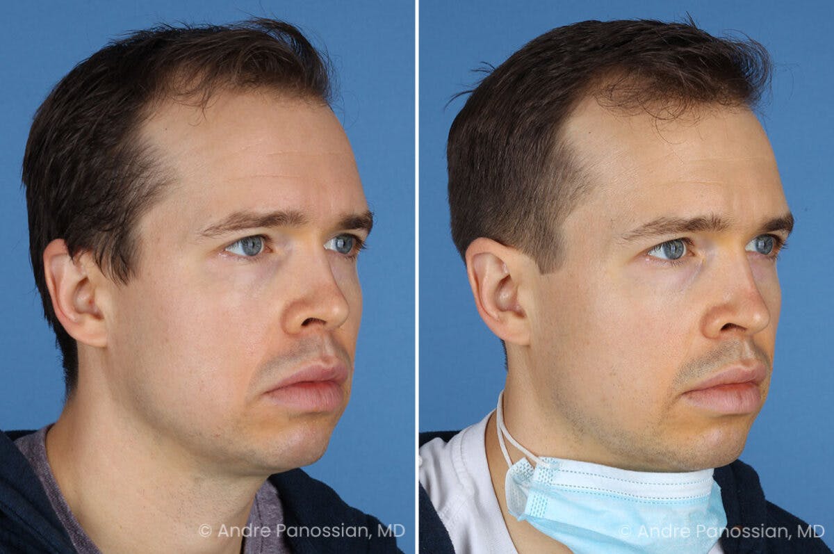 Ear Pinning (Otoplasty) Before & After Gallery - Patient 365074 - Image 2