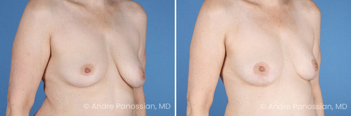 Breast Lift/Reduction Before & After Gallery - Patient 330732 - Image 2