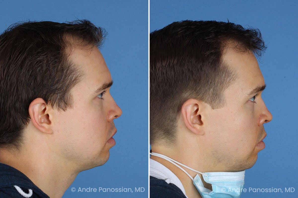 Ear Pinning (Otoplasty) Before & After Gallery - Patient 365074 - Image 3