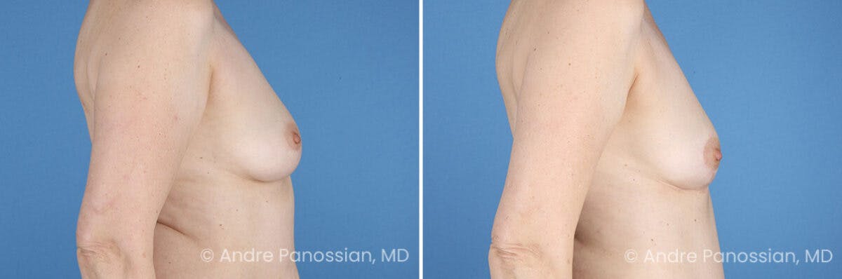 Breast Lift/Reduction Before & After Gallery - Patient 330732 - Image 3