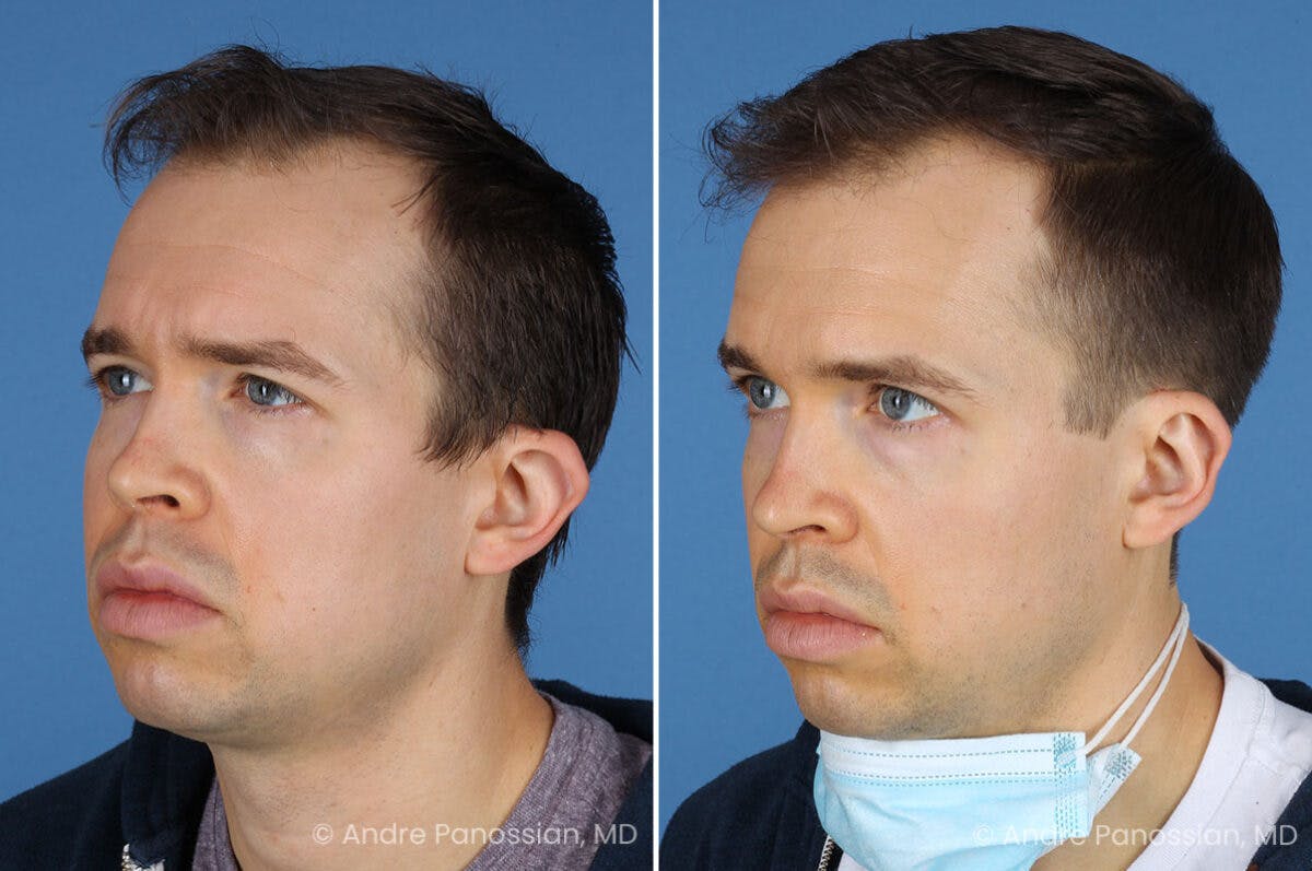 Ear Pinning (Otoplasty) Before & After Gallery - Patient 365074 - Image 4