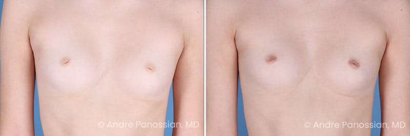 Inverted Nipple Correction Before & After Gallery - Patient 238959 - Image 1