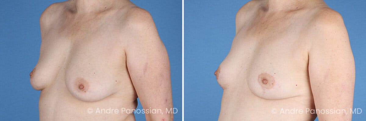Breast Lift/Reduction Before & After Gallery - Patient 330732 - Image 4