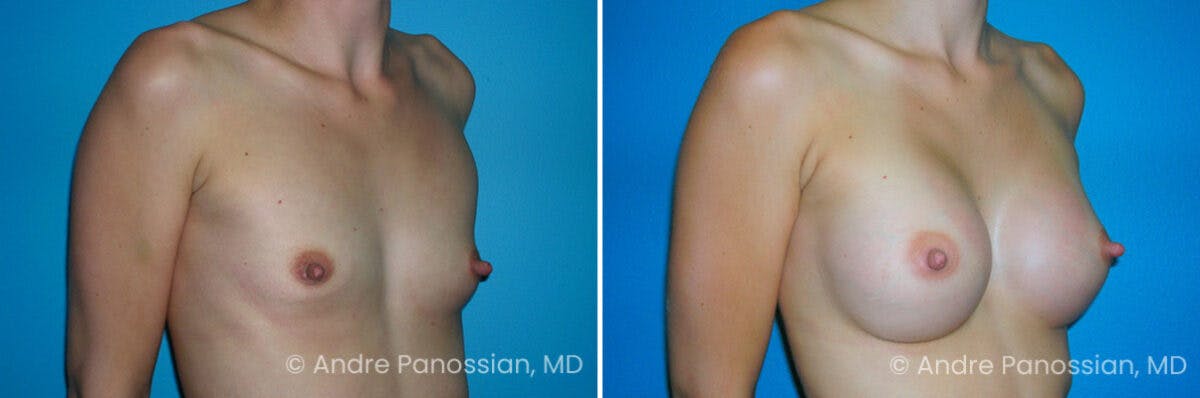 Breast Augmentation Before & After Gallery - Patient 697981 - Image 1